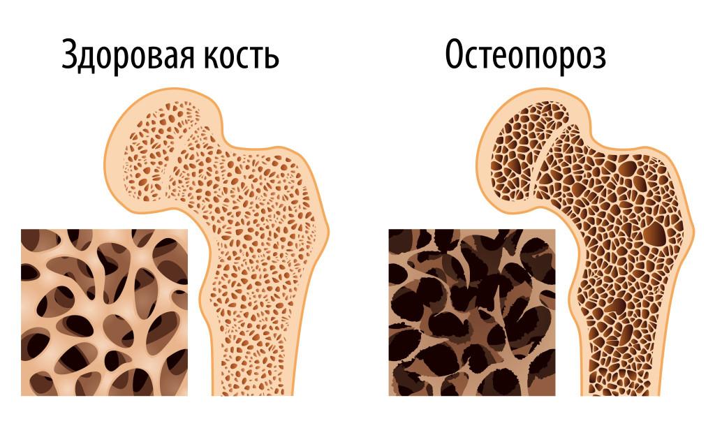 Остеопороз у детей презентация