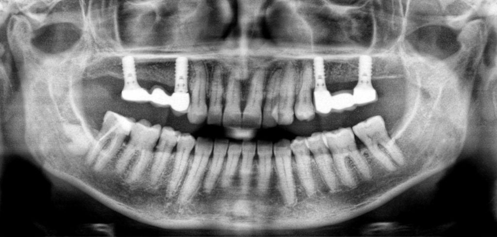 Остеопороз челюсти лечение народными средствами thumbnail