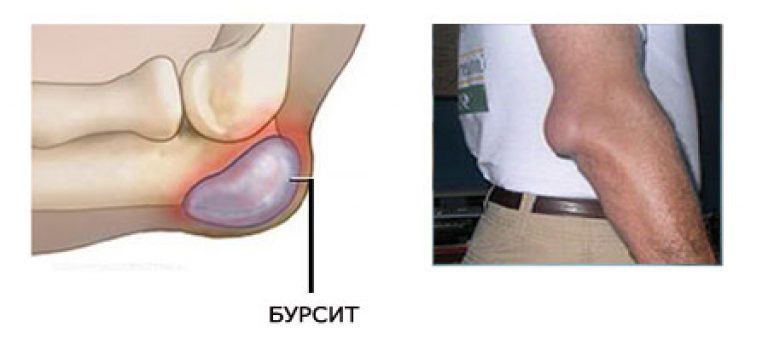 Изображение - Отек локтевого сустава лечение Bursit-loktevogo-sustava