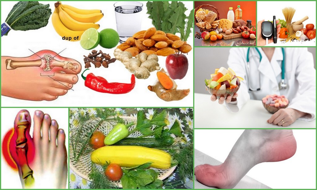Какие фрукты можно есть при подагре. Питание при подагре. Подагра — лечебная диета. Профилактика приступов подагры.
