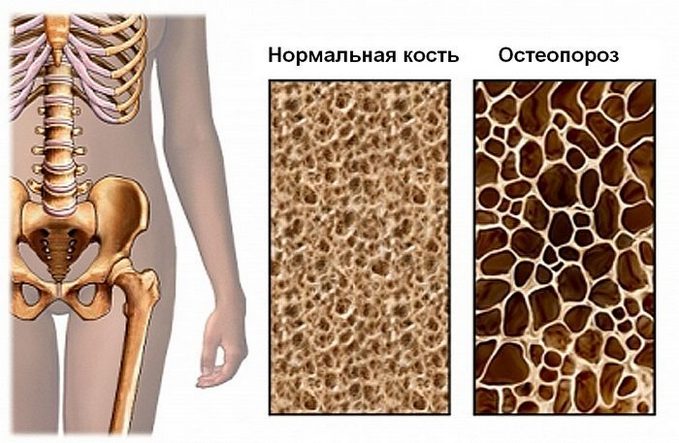 Лечение остеохондроза остеопороз поясничного отдела thumbnail