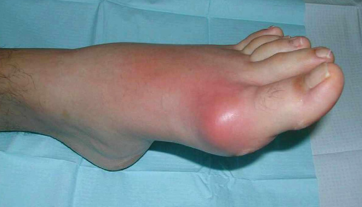 Медицина подагра в ногах лечение thumbnail