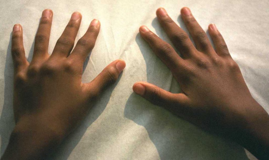 Подагра признаки на руках и лечение у женщин народными средствами thumbnail