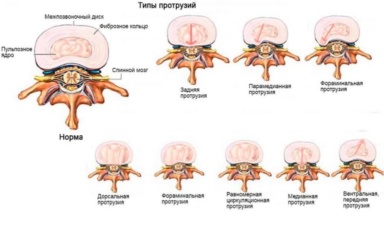 Протрузия позвоночника фото